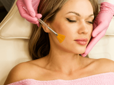 Peeling Químico