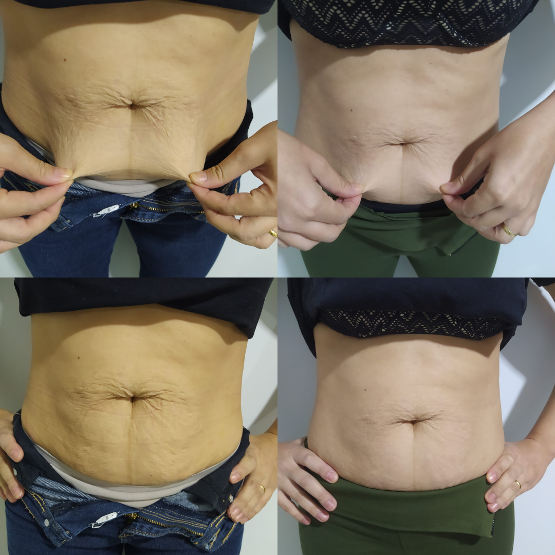 Resultado Bioestimulador Corporal