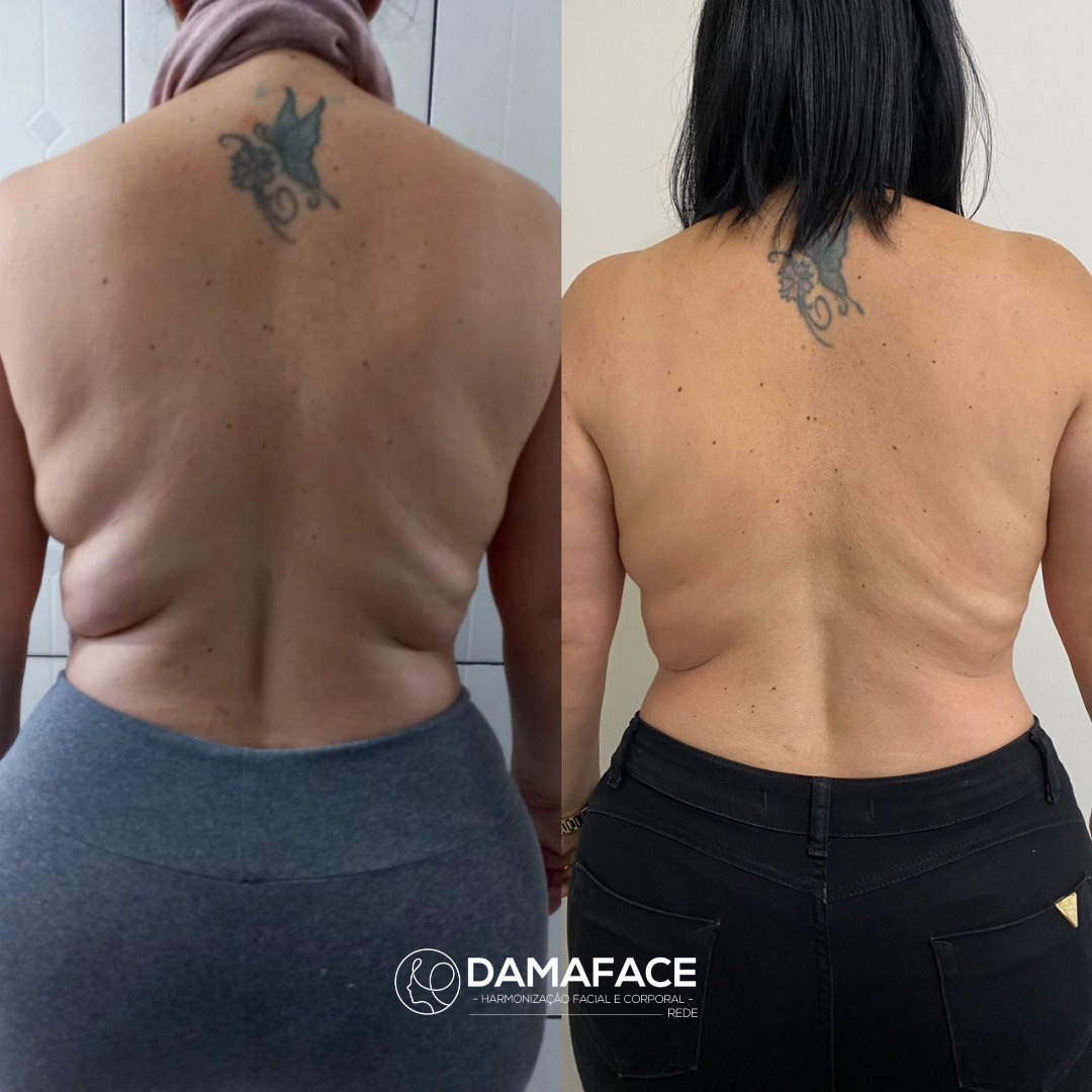 Transformação na Gordura Abdominal com Enzimas - Antes e Depois 3