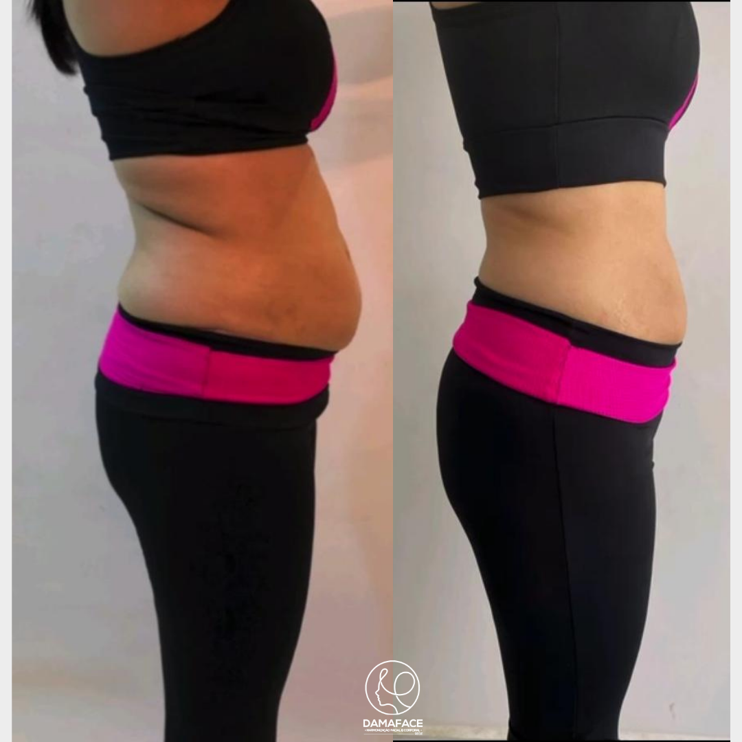 Gordura Localizada Diminuída no Abdômen - Antes e Depois 4