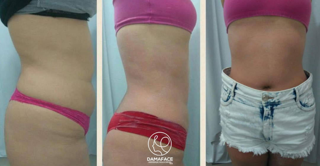 Melhora Visível na Região Abdominal - Antes e Depois 5