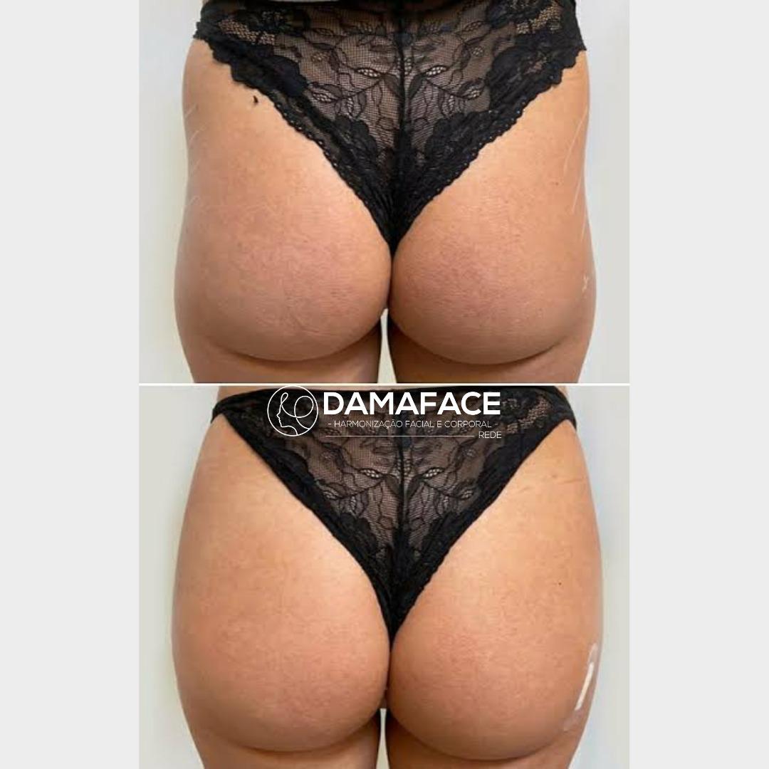 Preenchimento de Glúteos Antes e Depois