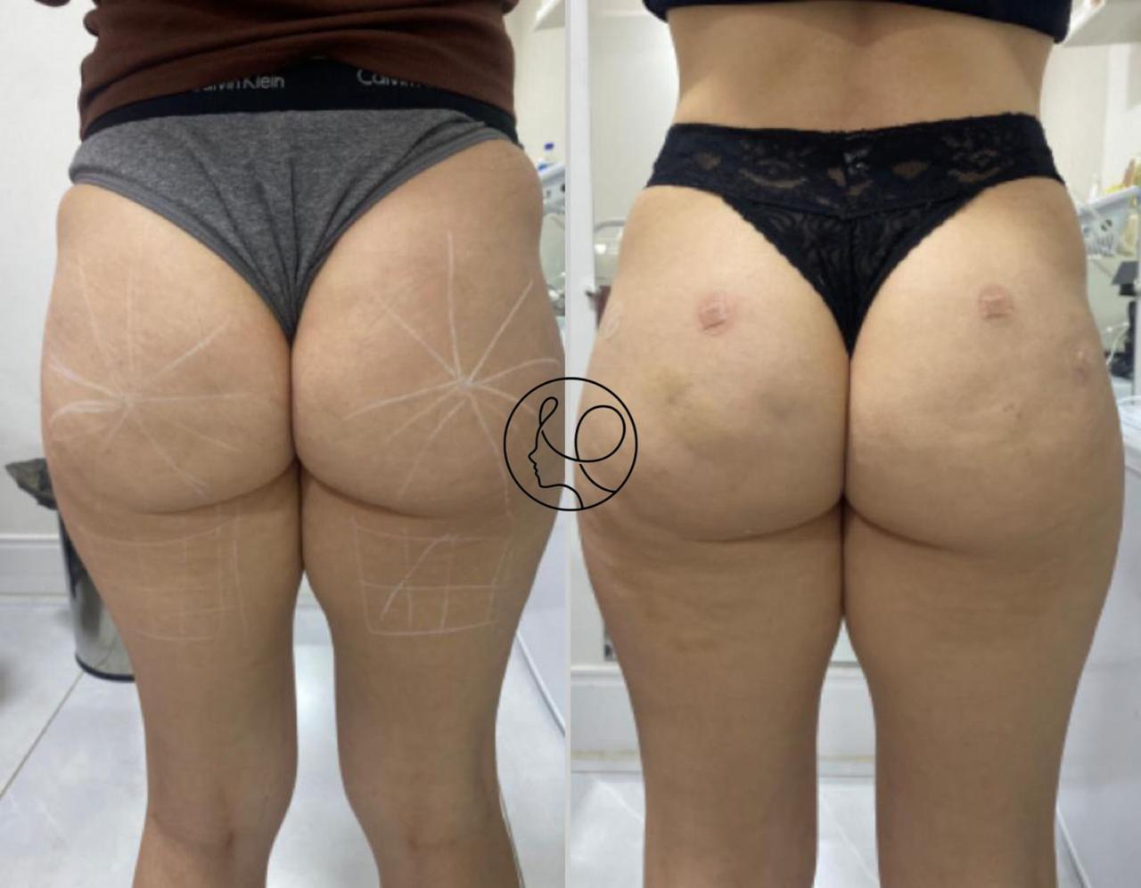 Correção de Hip Dips com Preenchimento