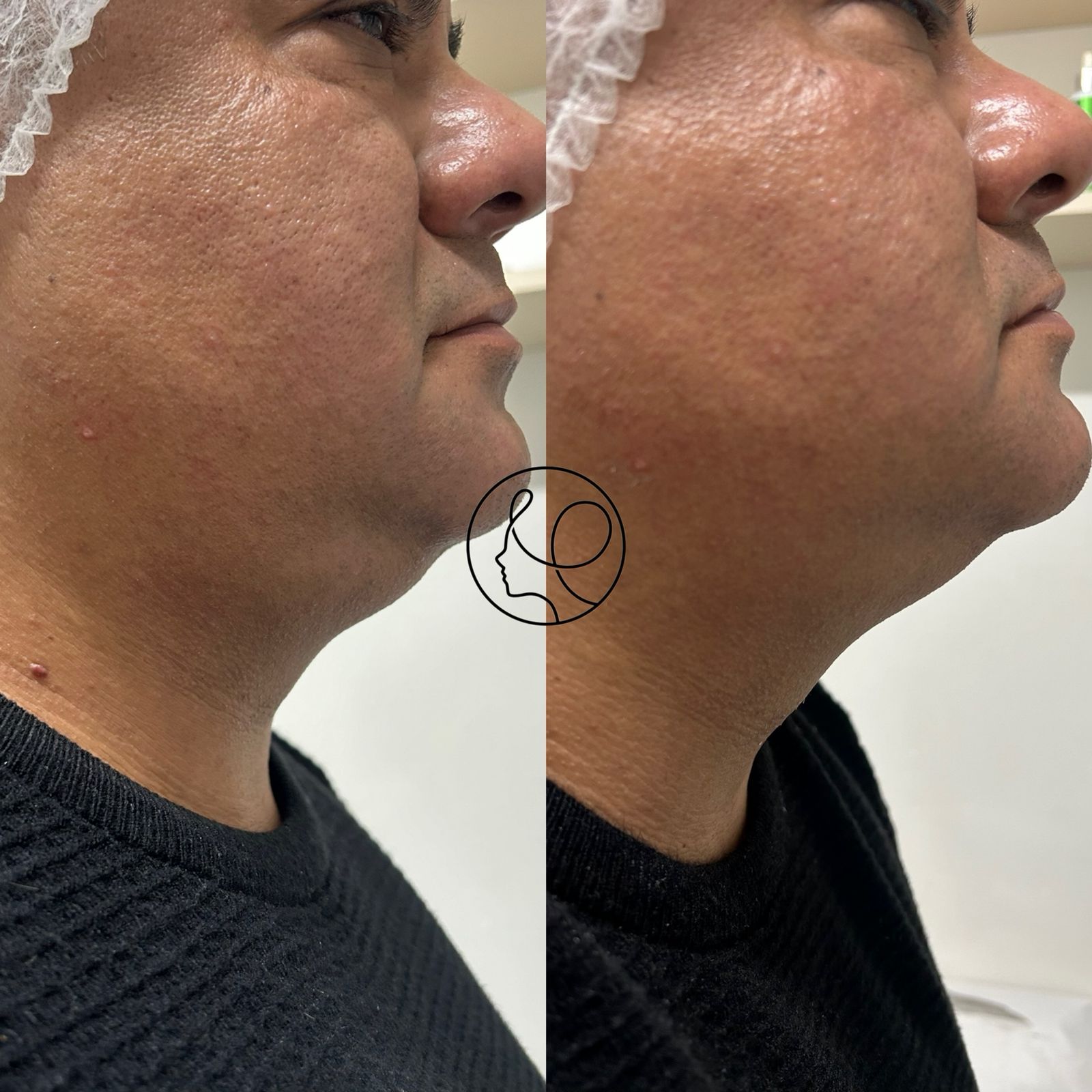 Ultraformer Resultado Pescoço