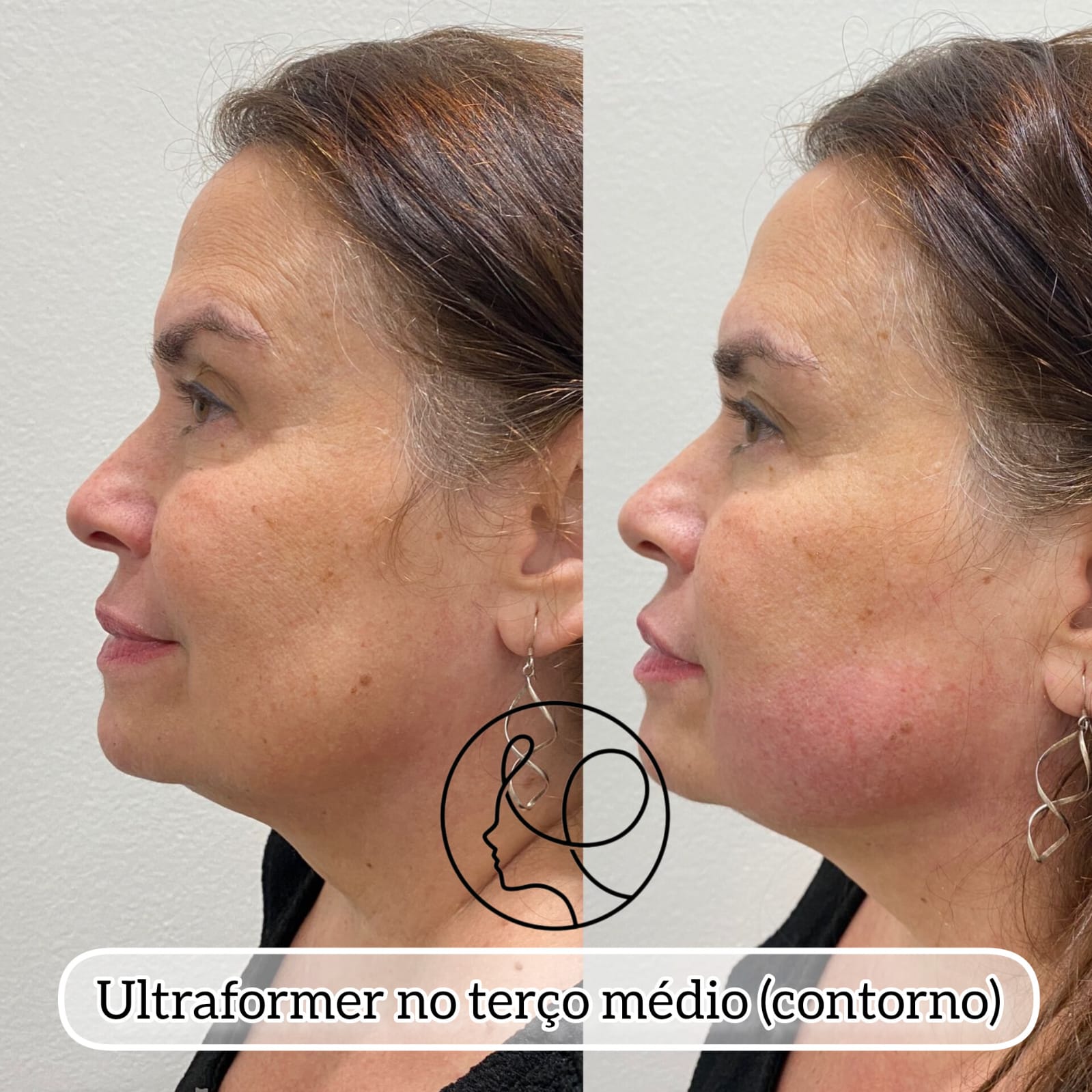 Ultraformer Antes e Depois Rosto