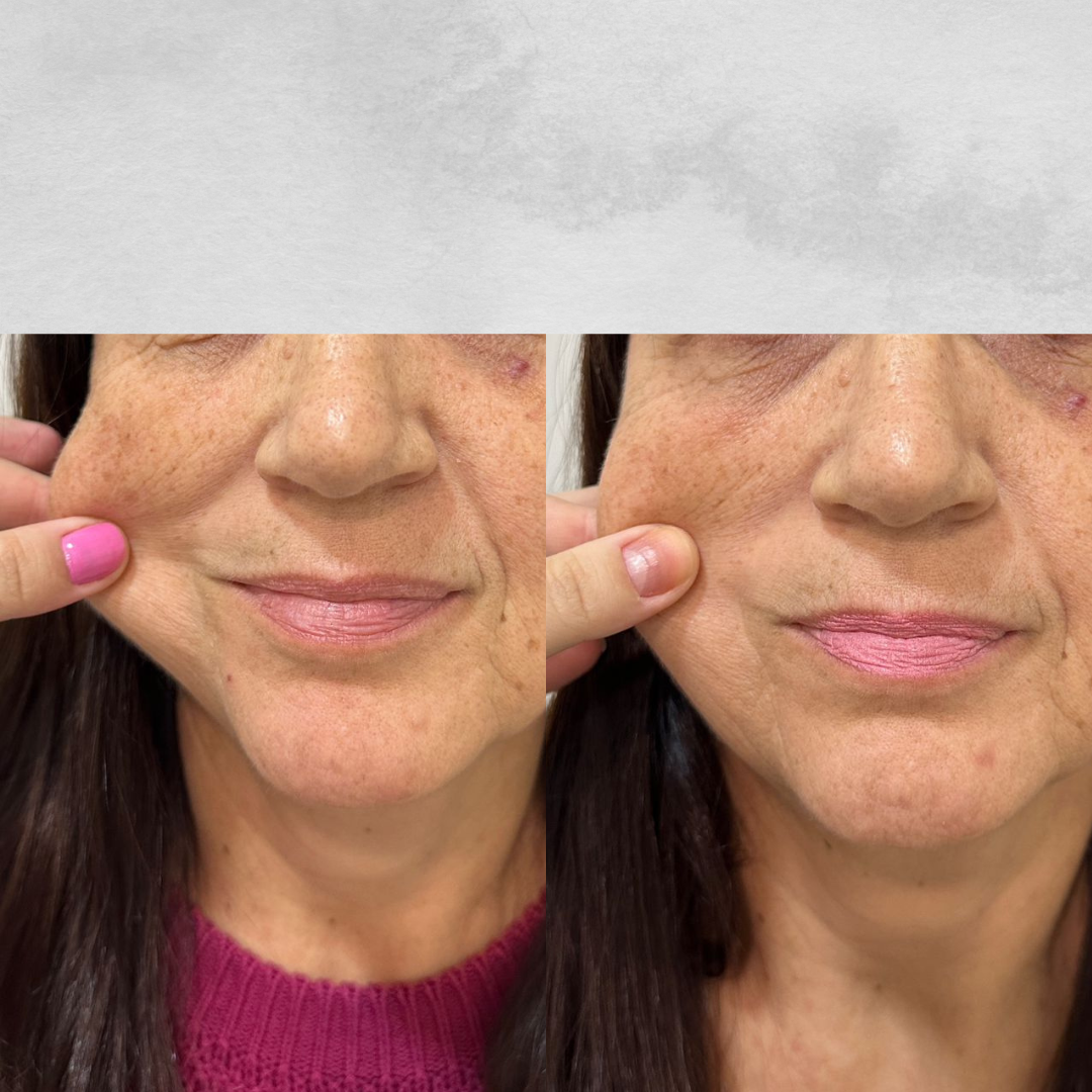 Bioestimulador de Colágeno Antes e Depois