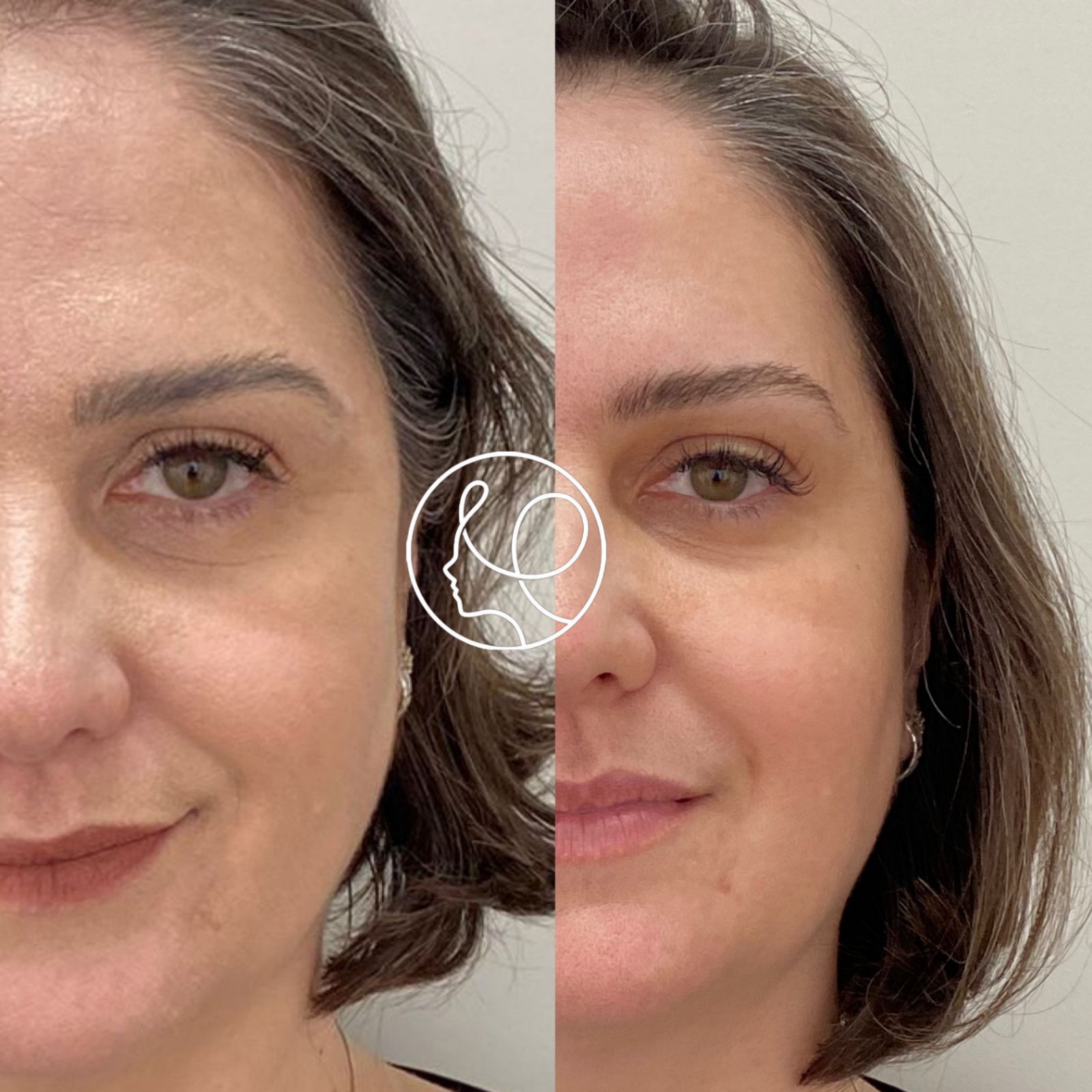 Tratamento com Bioestimulador