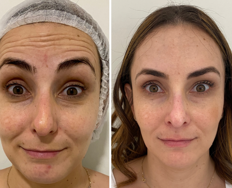 Botox Antes e Depois
