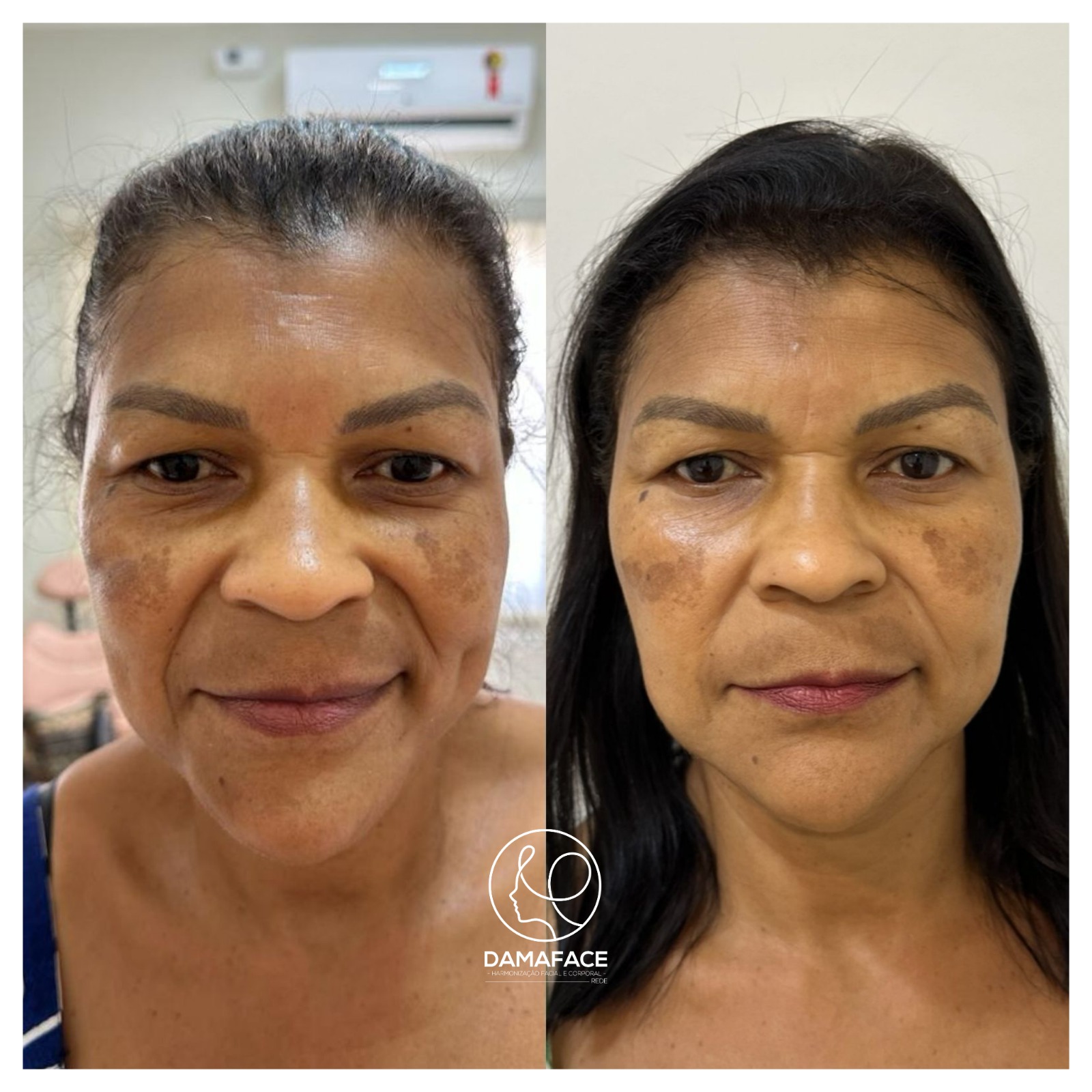 Lifting com Fios de PDO