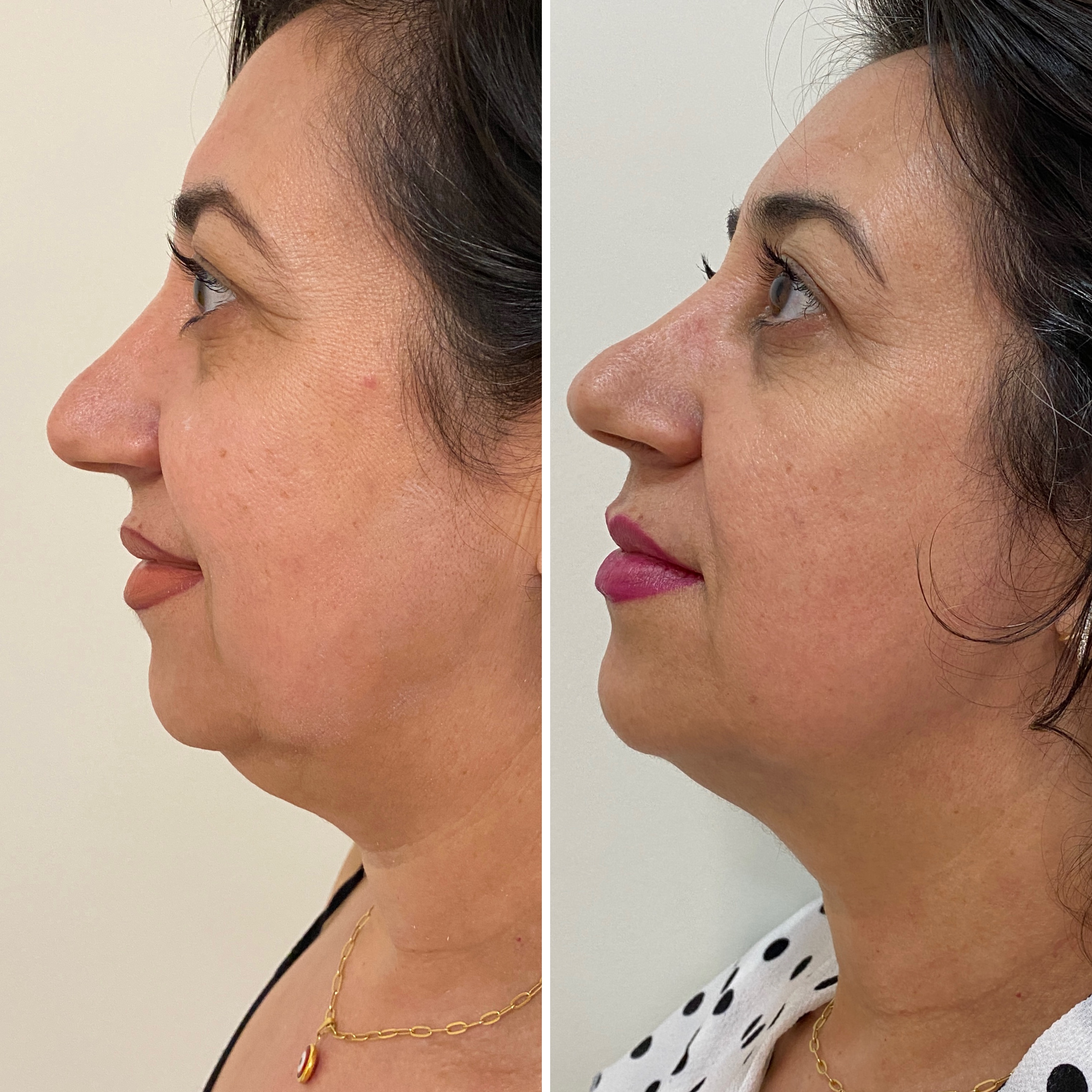 Lipo de Papada Antes e Depois