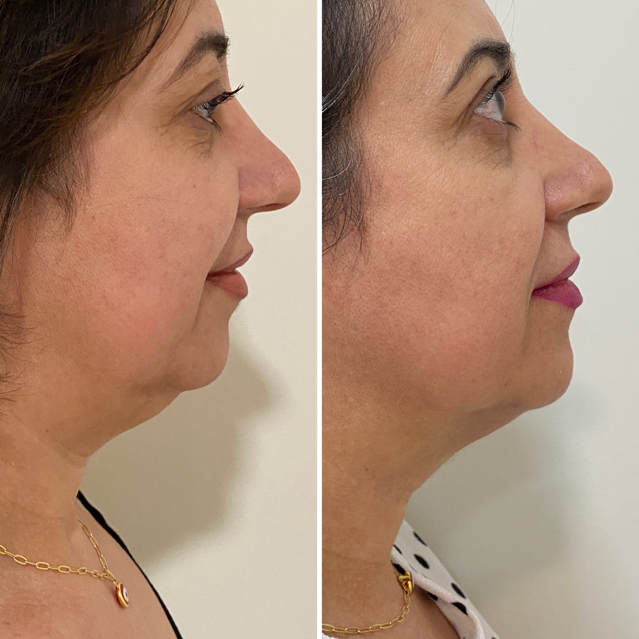 Resultado Lipo de Papada