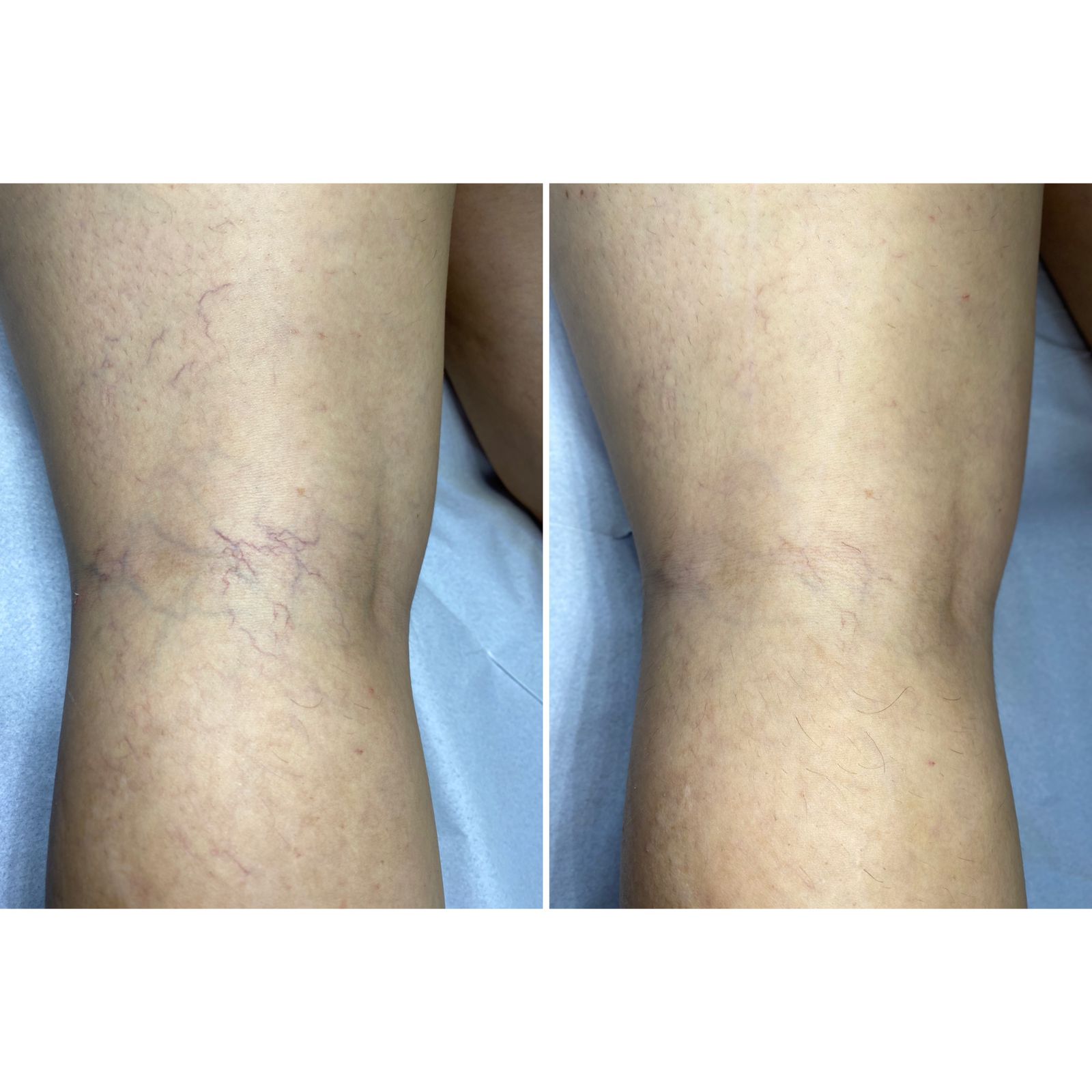 Secagem de Vasinhos nas Pernas