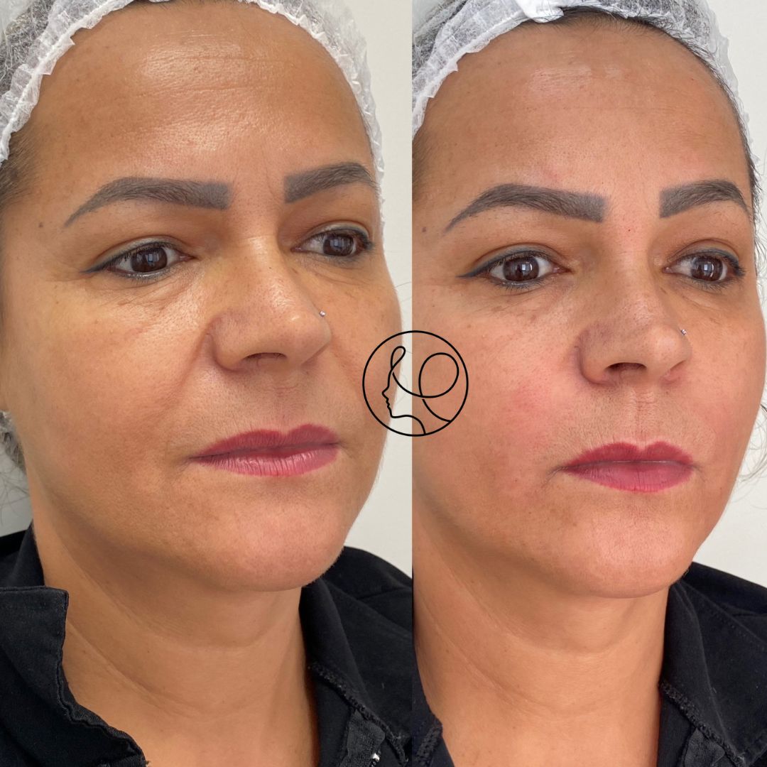 Preenchimento Bigode Chinês