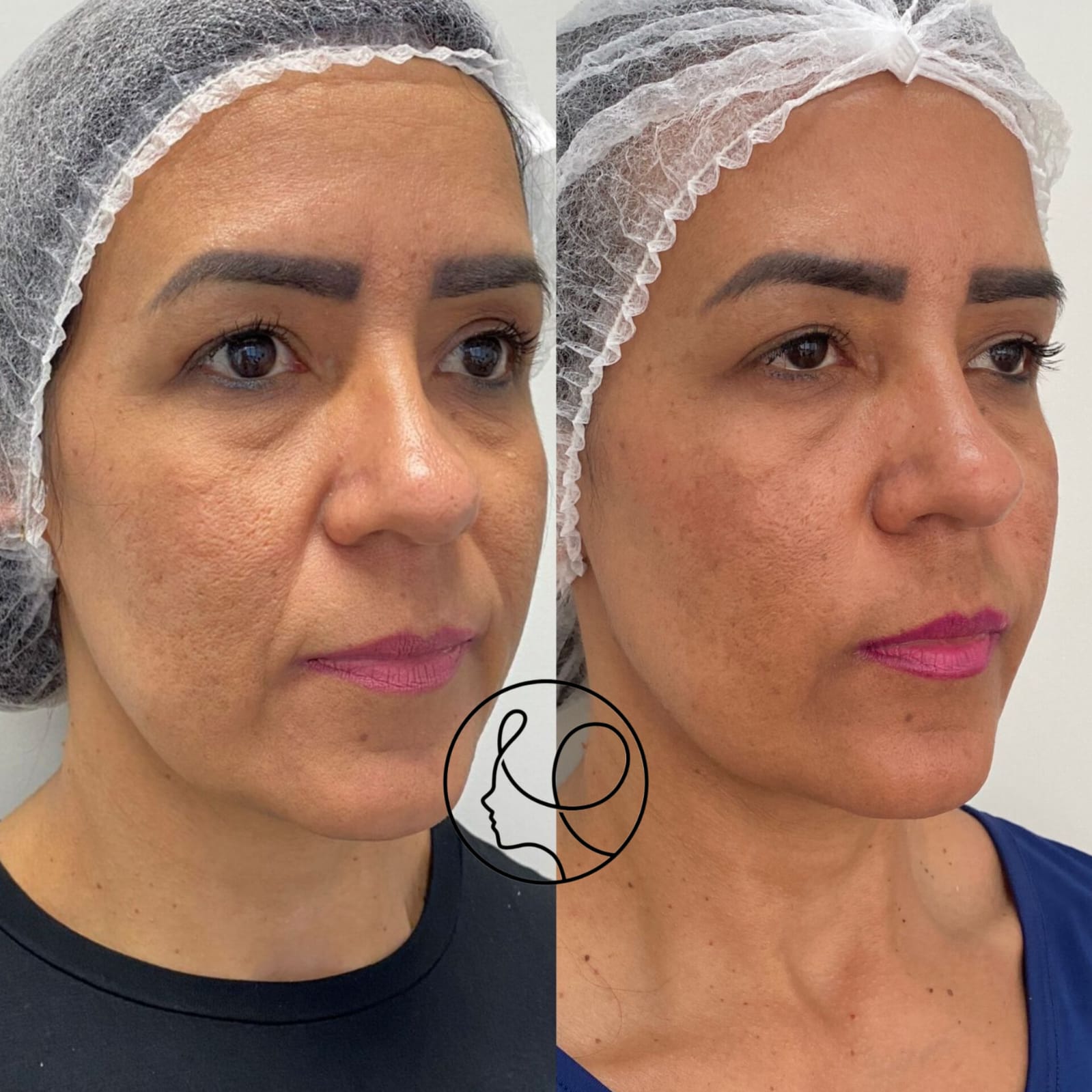 Resultado Sulco Nasogeniano