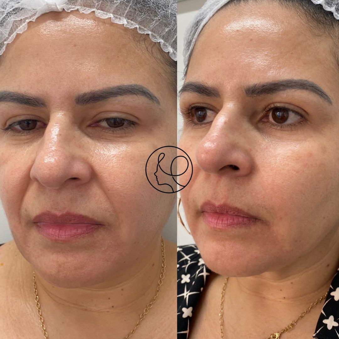 Antes e Depois Bigode Chinês