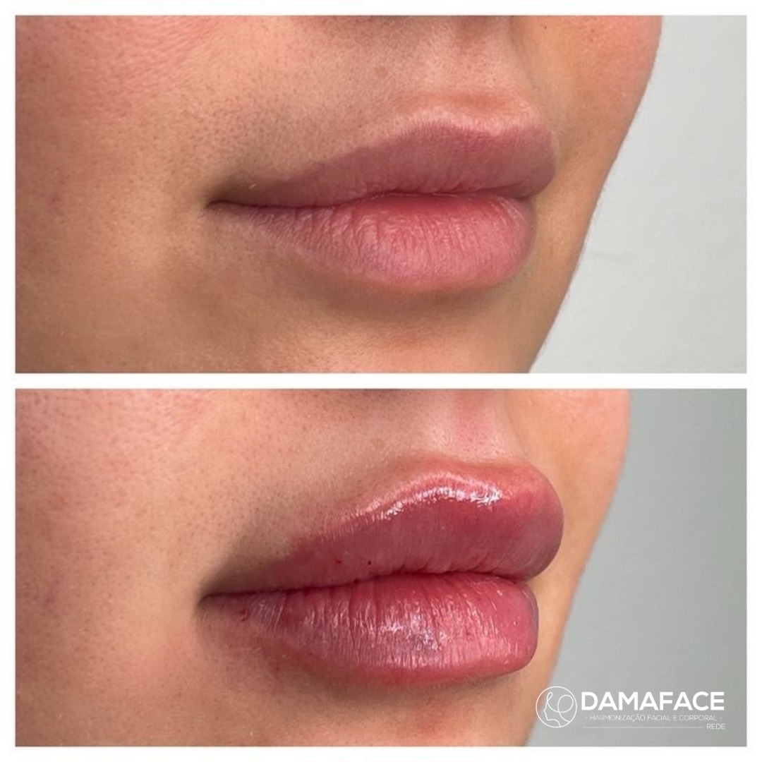 Preenchimento Labial Antes e Depois