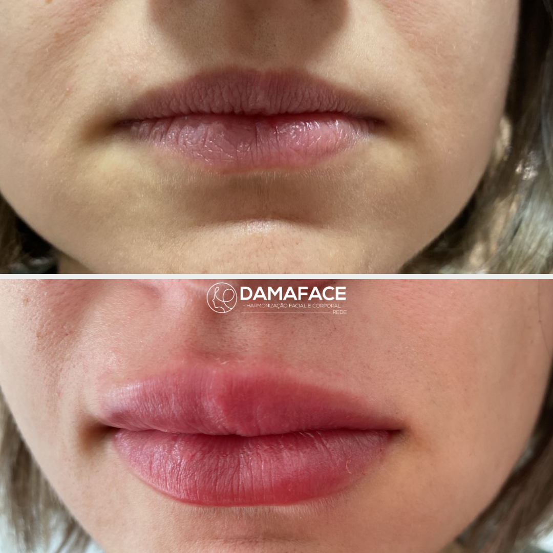 Resultado Preenchimento Labial