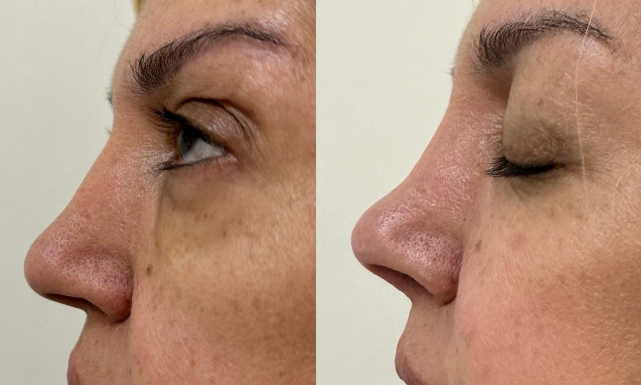 Rinomodelação Antes e Depois