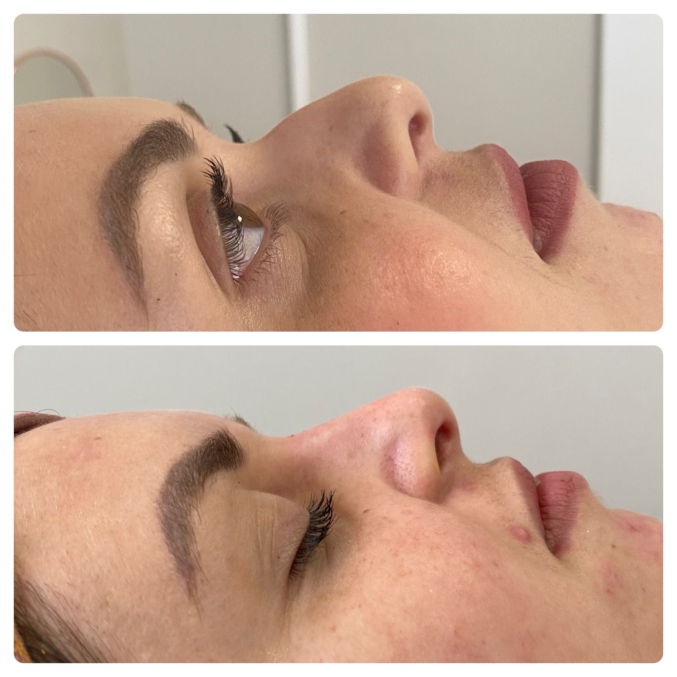 Resultado Rinomodelação